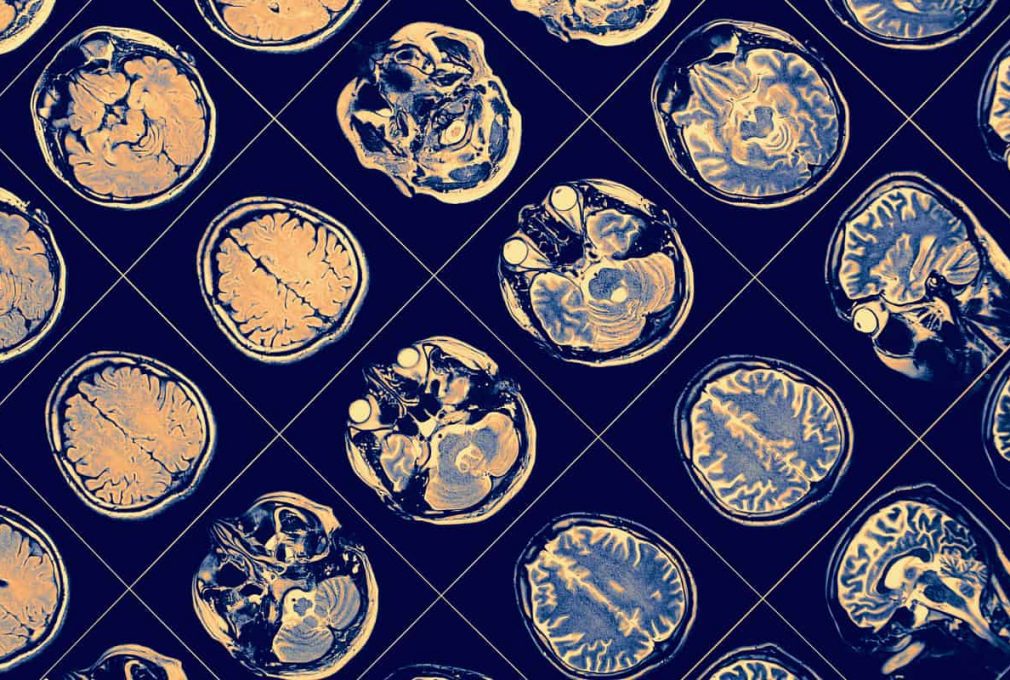 brainomix funding