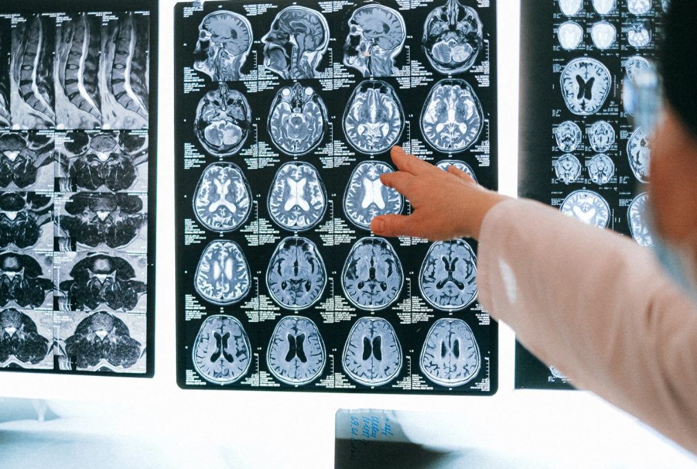 Brain tumour imaging