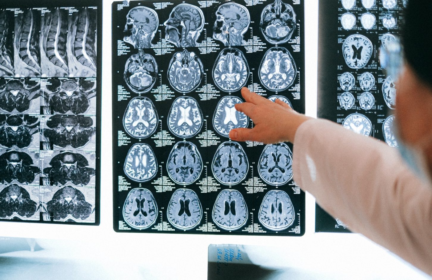 Brain tumour imaging