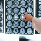 Brain tumour imaging