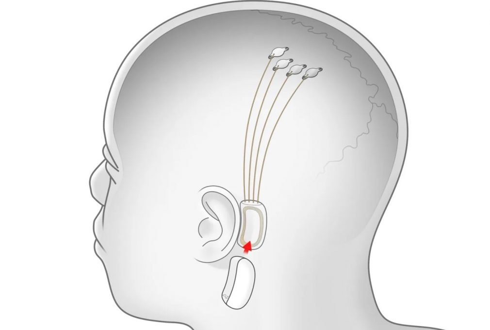 neurotech discrimination