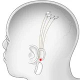 neurotech discrimination