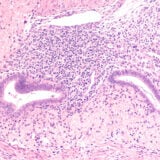 endometriosis