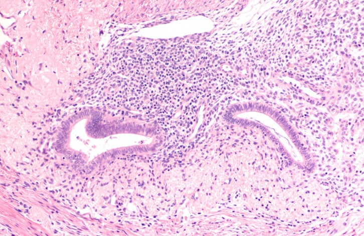 endometriosis